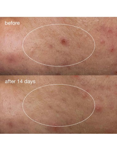 Dermalogica Deep Breakout Liquid Patch